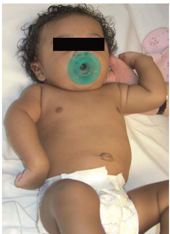 <p>The clinical manifestations are related to the paralysis of the affected extremity and muscles. </p><p><span style="color: yellow"><strong>The arm hangs limply alongside the body. The shoulder and arm are adducted and internally rotated; the elbow is extended, and the forearm is pronated, with the wrist and fingers flexed. </strong></span></p><p>In newborns with very severe deficits, the arm may be cooler because of the sympathetic nervous system outflow at T1. </p><p><span style="color: yellow"><strong>Torticollis is commonly present and almost always with the face turned away from the involved arm</strong></span></p>