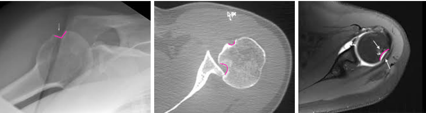 <p>What kind of deformity can be seen here?</p>