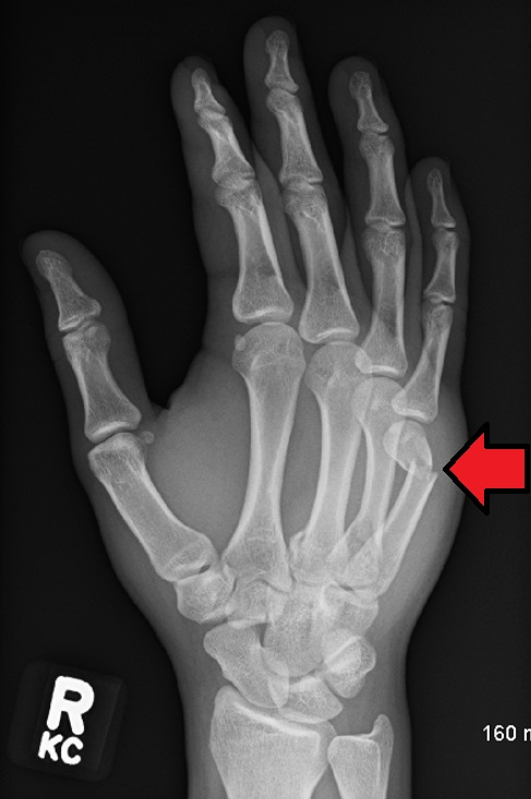 <p>radiolucent ‘boxer’s fracture’/fracture + lateral displacement of the head of the fifth metacarpal</p><p></p>