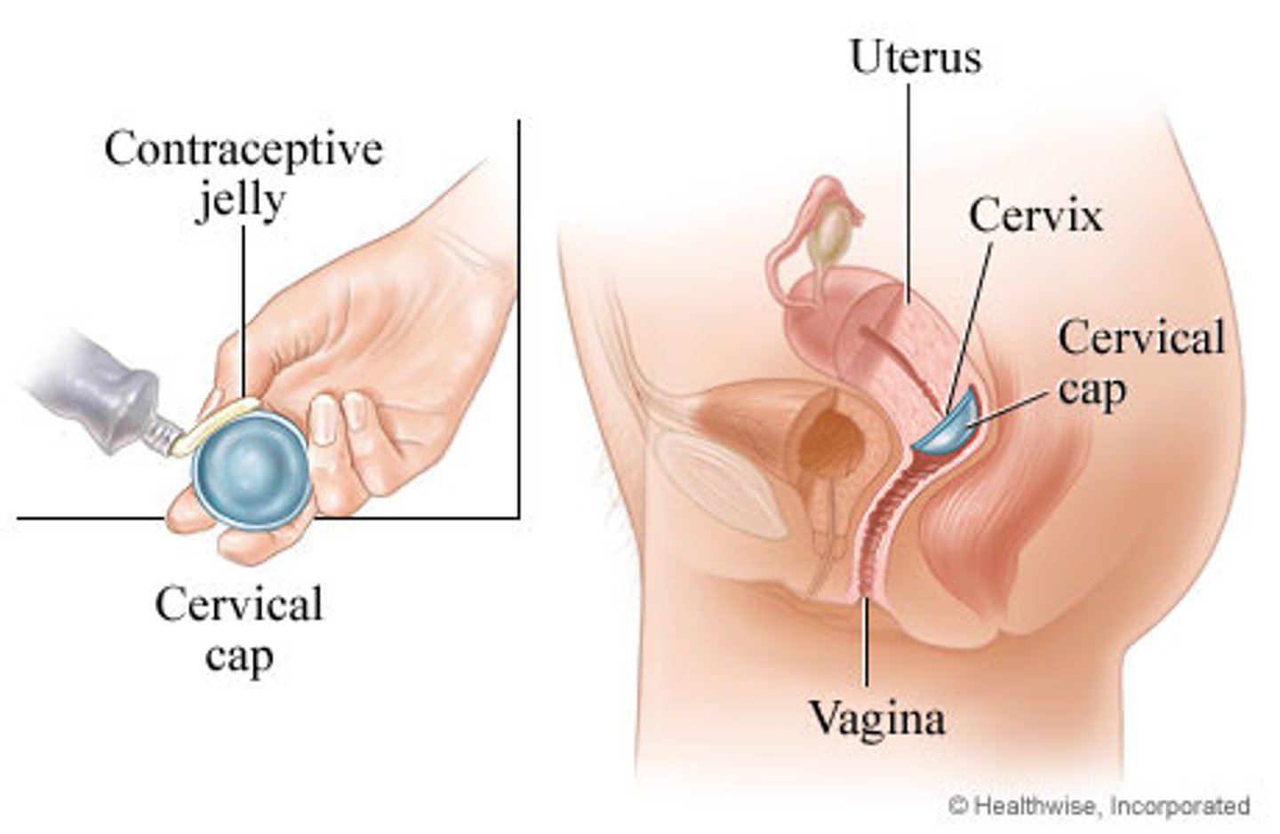 <p>Fits with suction over the cervix</p><p>More difficult to insert and remove than the diaphragm</p>