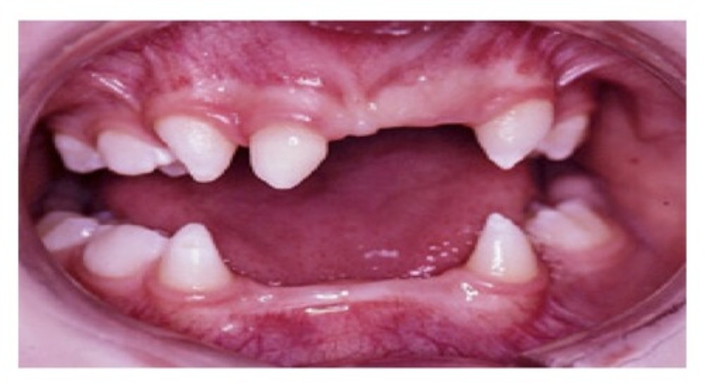 <p>Hypodontia can be associated with the syndrome of ——————— ——————— because many parts of the tooth are indirectly or directly of ectodermal origin.</p>