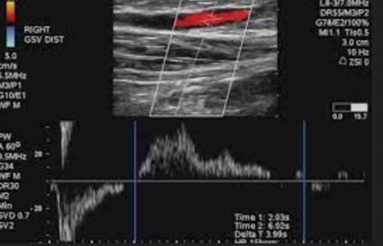 <p><span>Patient c/o heavy, tired RLE with persistent swelling relieved with elevation of leg. Will&nbsp; this ultrasound finding explain symptoms&nbsp;</span></p>