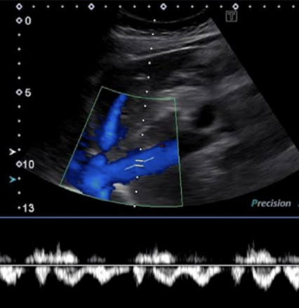 <ul><li><p>complex, <u>spontaneous</u>, <u>above and below baseline</u></p></li><li><p>variations with respiration cycle</p></li></ul><p></p>
