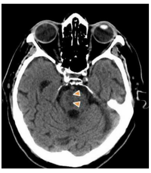 <p>A CT scan from a 60-year-old male with sudden onset weakness reveals the result shown in the accompanying image. He first noticed the weakness about 30 minutes ago. He is alert to person, time and place. His pupils are equal, round and reactive to light and accommodation. The infarct (indicated by the arrowheads) is within what vascular territory?</p><p>A. Anterior choroidal</p><p>B. Lenticulostriate</p><p>C. Long circumferential branches from the basilar</p><p>D. Paramedian branches from the basilar</p><p>E. Paramedian branches from the posterior cerebral</p><p>F. Thalamoperforators</p>