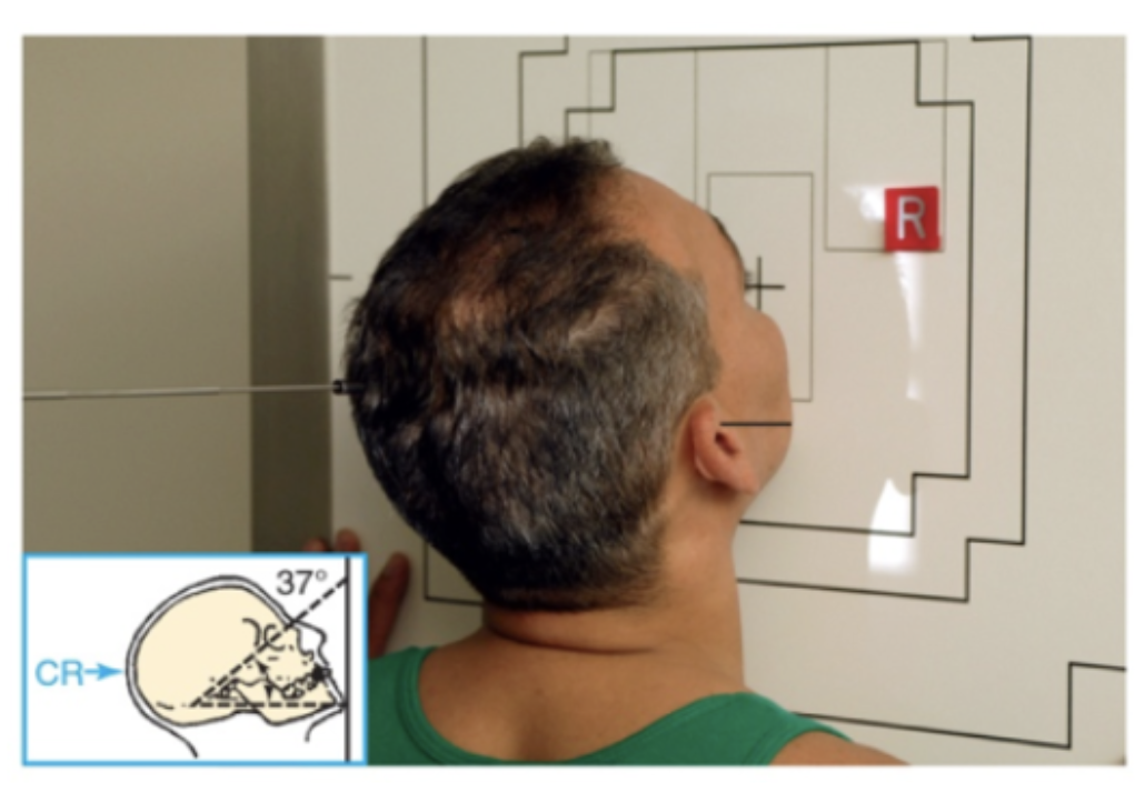 <p>What <u>lines</u> are used for <strong>Parietocanthial Projection: Waters method </strong>for <strong>facial bone</strong>?</p>