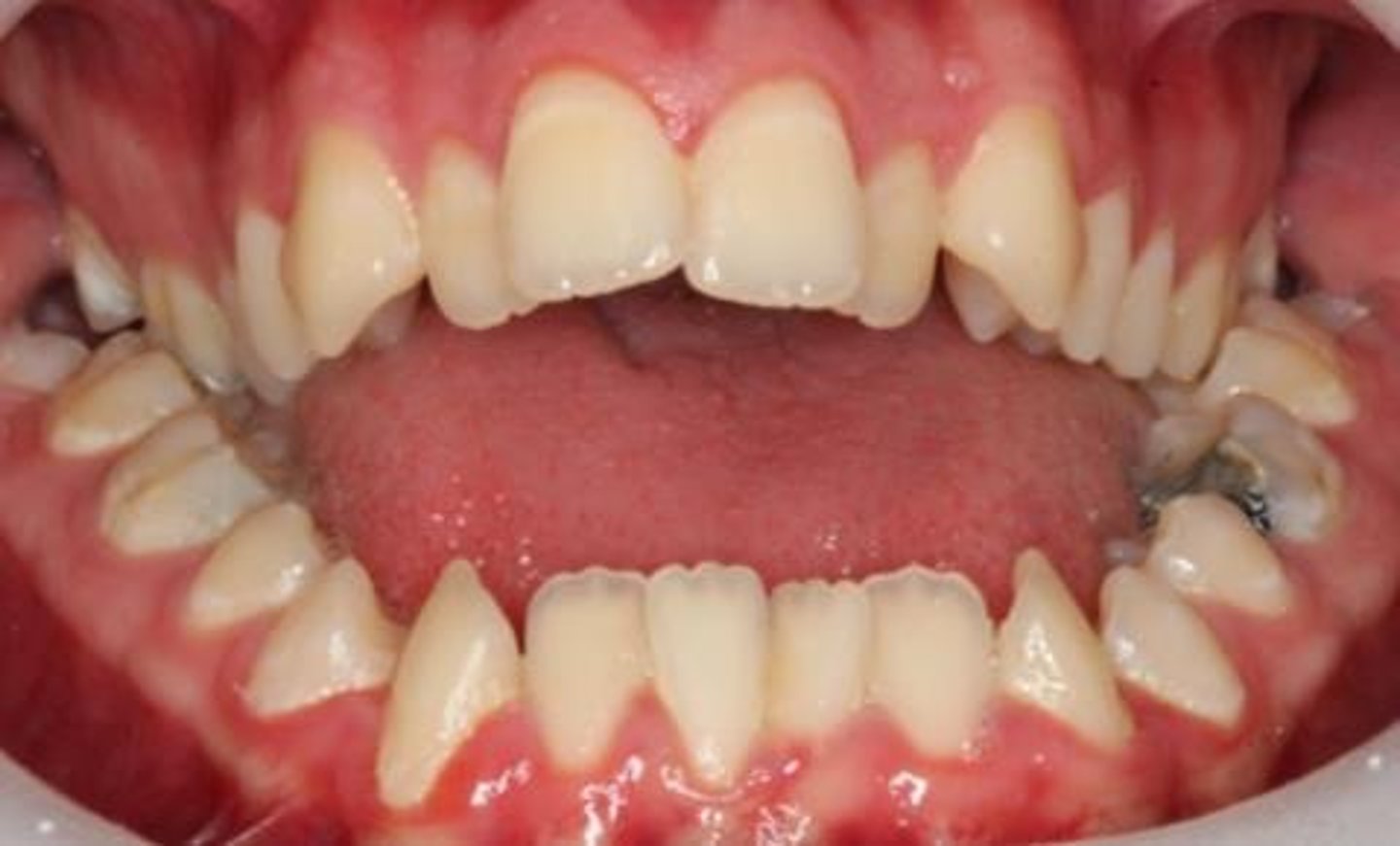 <p>Misalignment of teeth and jaws.</p>