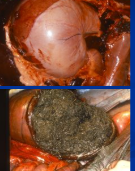 <p><span style="background-color: transparent;">Gastric Impaction</span></p>