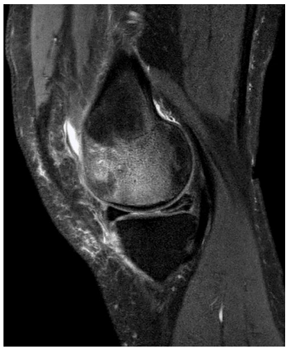 <p>What does this MRI image show?</p>