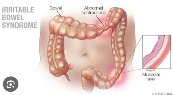 <p><span style="font-family: Droid Sans Mono, monospace">IRRITABLE BOWEL SYNDROME (IBS)</span></p>