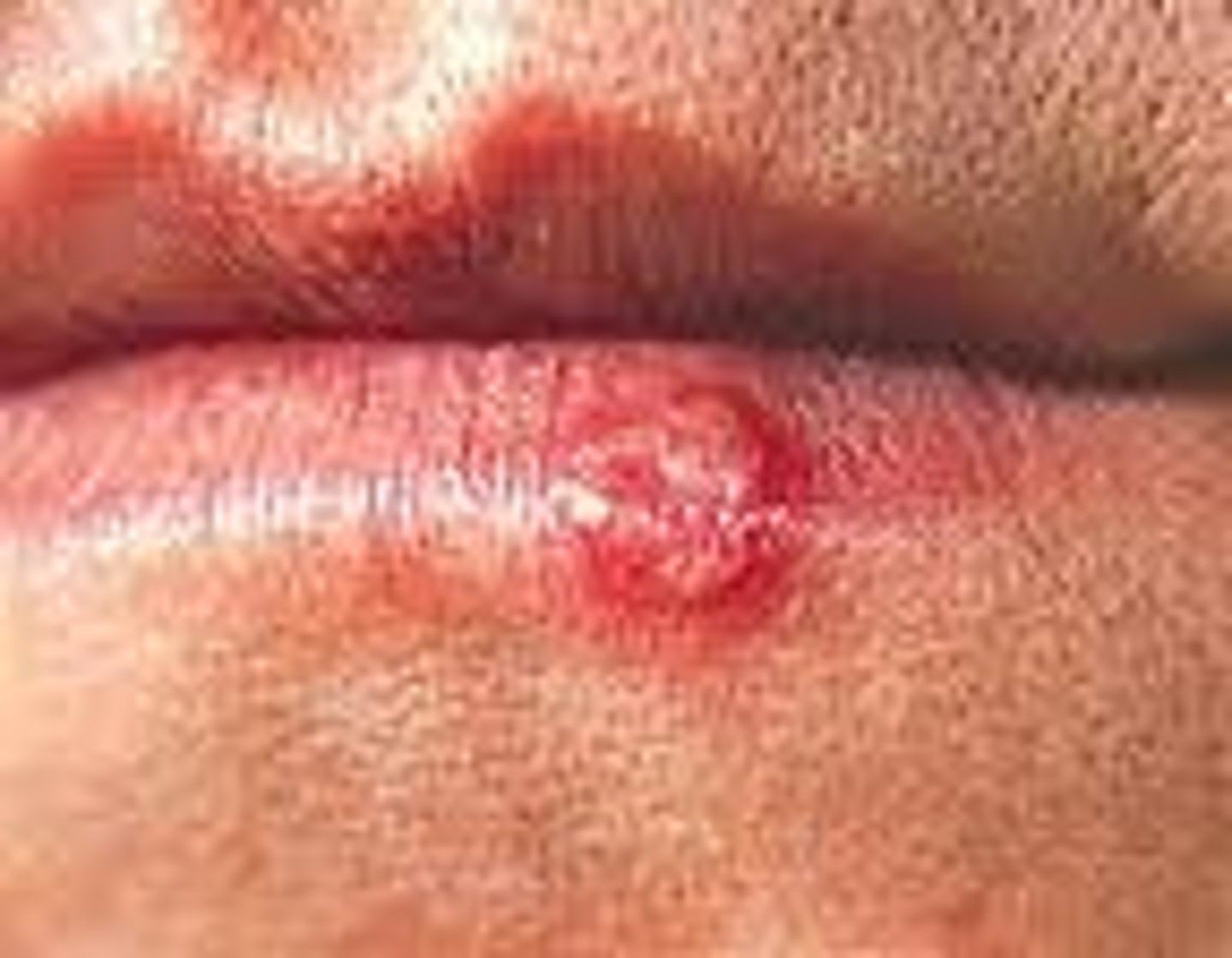 <p>Viral infection. No cure. (cold sore, STD, chicken pox)</p>