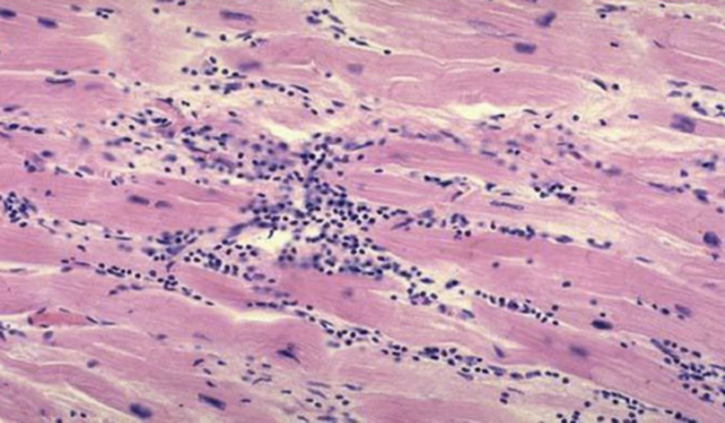 <p>Coagulative necrosis </p>