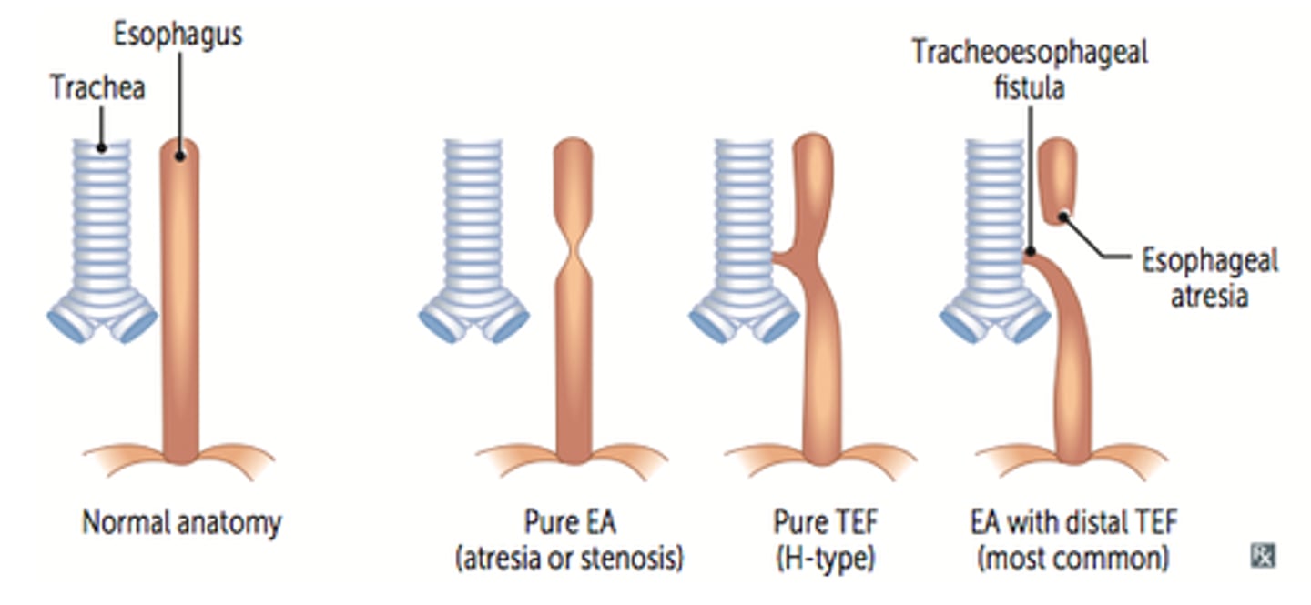 <p>It causes the esophagus to end in ablind-ended pouch rather than connecting normally to the stomach</p>