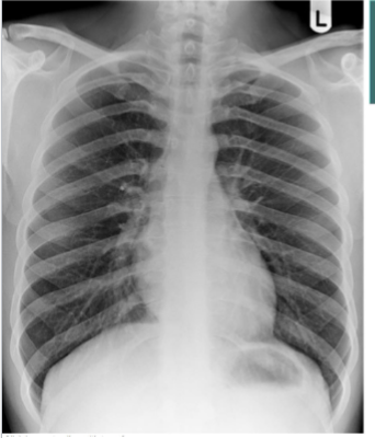 <p>identify costophrenic angles </p>