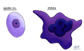 <p>lack of differentiation&nbsp;</p><p>considered hallmark of malignancy</p>