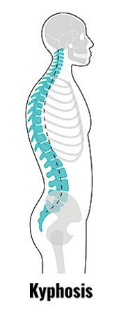 <p>exaggerated thoracic deviation/ curvature </p>