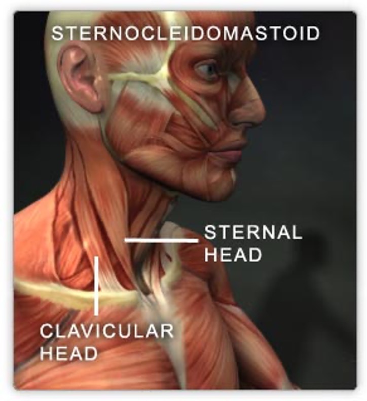 <p><strong>origin:</strong> two heads</p><p>-sternal head: anterior surface of manubrium of sternum</p><p>-calvicular head: superior surface of medial 1/3 of clavicle</p><p><strong>insertion:</strong> mastoid process</p><p><strong>innervation:</strong></p><p>- motor- spinal portion CN XI</p><p>-pain/pripriooception- C2 and C3</p><p><strong>action:</strong></p><p>-bilaterally- flexion of head, elevate sternum during forceful inhalation</p><p>-unilaterally- rotate had towards opposite side of contracting muscle</p>