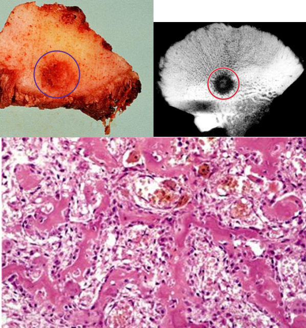 <p><strong><span style="color: red">benign, small (< 2.0 cm) lesions</span> that usually involves the <span style="color: red">tibia &amp; femur (long bones)</span></strong></p><ul><li><p><strong><mark data-color="blue">nidus of osteoid &amp; connective tissue (woven bone) surrounded by a dense sclerotic bone shell</mark></strong></p><ul><li><p><strong><mark data-color="blue">nidus RADIOLUCENT on X-ray</mark></strong></p></li></ul></li></ul><p>clinical presentation</p><ul><li><p>occur in <strong><mark data-color="green">male teenagers &amp; young adults</mark></strong></p></li><li><p><strong><mark data-color="green">pain @ night (cause by prostaglandin E<sub>2</sub>) that is relieved by aspirin</mark></strong></p></li></ul>