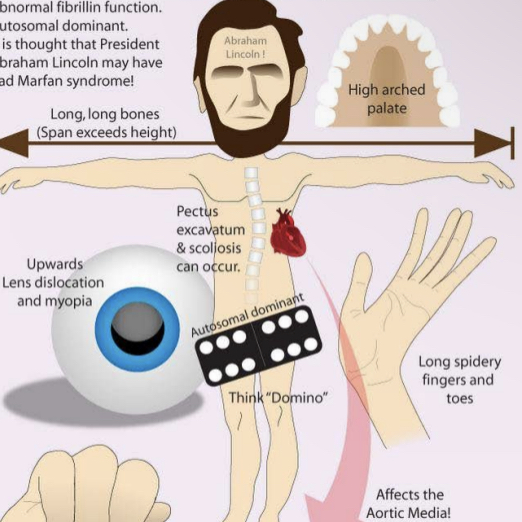 <p>What’s Marfan syndrome </p>