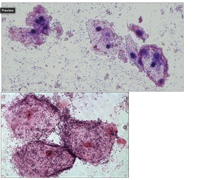 <p>The following images are from a vaginal gram stain:</p><p>&nbsp;&nbsp;&nbsp;</p><p>What are these cells called and what infectious condition are they associated with?</p><p>&nbsp;</p><p>normal squamous epithelial cells; no condition</p><p>&nbsp;</p><p>White Blood Cells; Cervicitis</p><p>&nbsp;</p><p>Clue Cells; Bacterial Vaginosis</p><p>&nbsp;</p><p>None of the above</p>