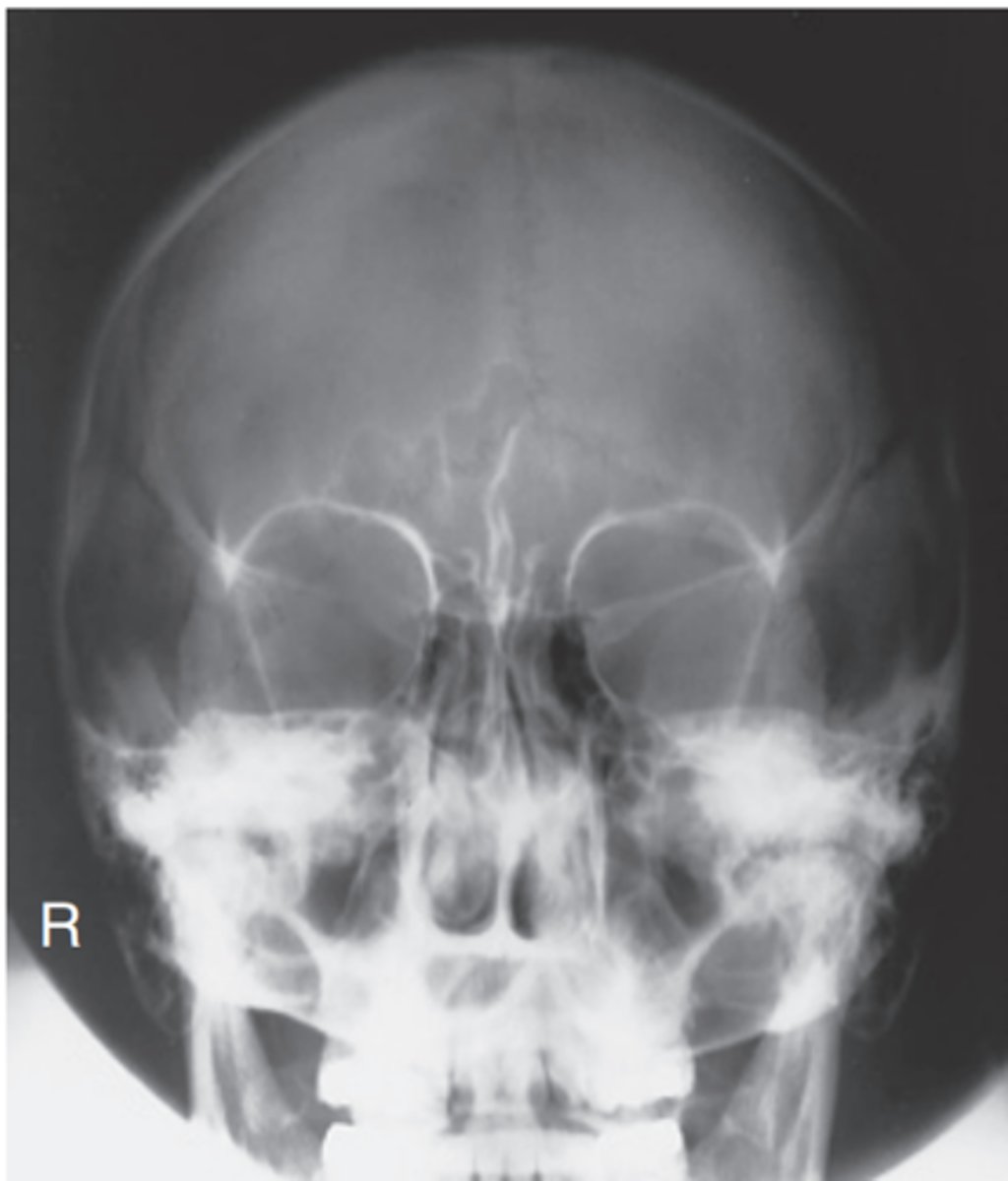 <p>-Position: No rotation as assessed by equal distance from the midlateral orbital margins to the lateral cortex of the cranium on each side, superior orbital fissures symmetric within the orbits, and correct extension of neck (OML alignment).</p><p>Petrous pyramids are projected into the lower one-third of the orbits. </p><p>• Supraorbital margin is visualized without superimposition</p>