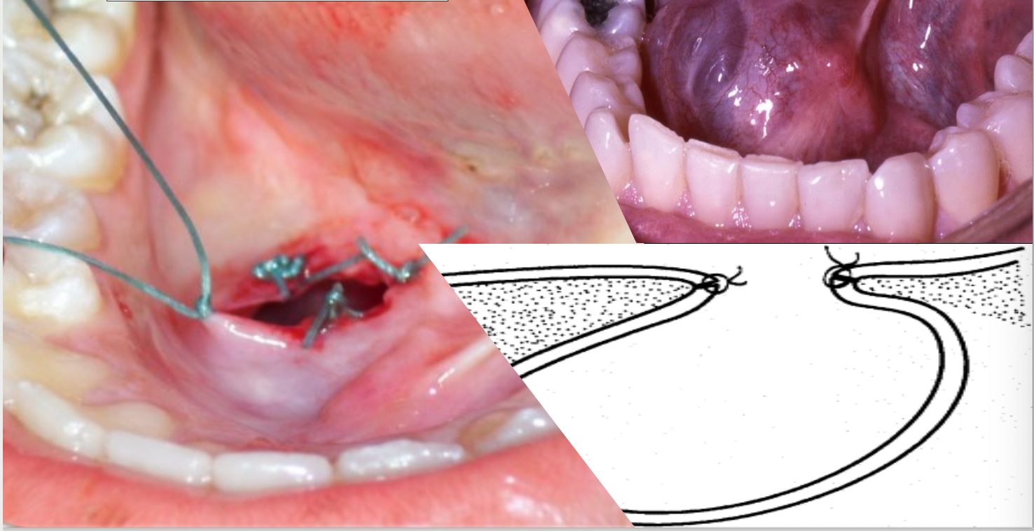 <p>What is the treatment for a ranula?</p>