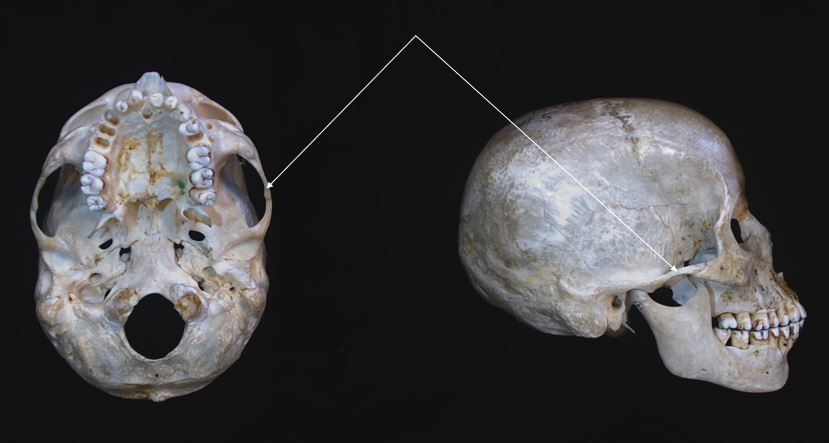 zygomatic process 