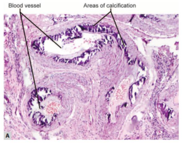 <p>more pics of hypercalcemia</p>