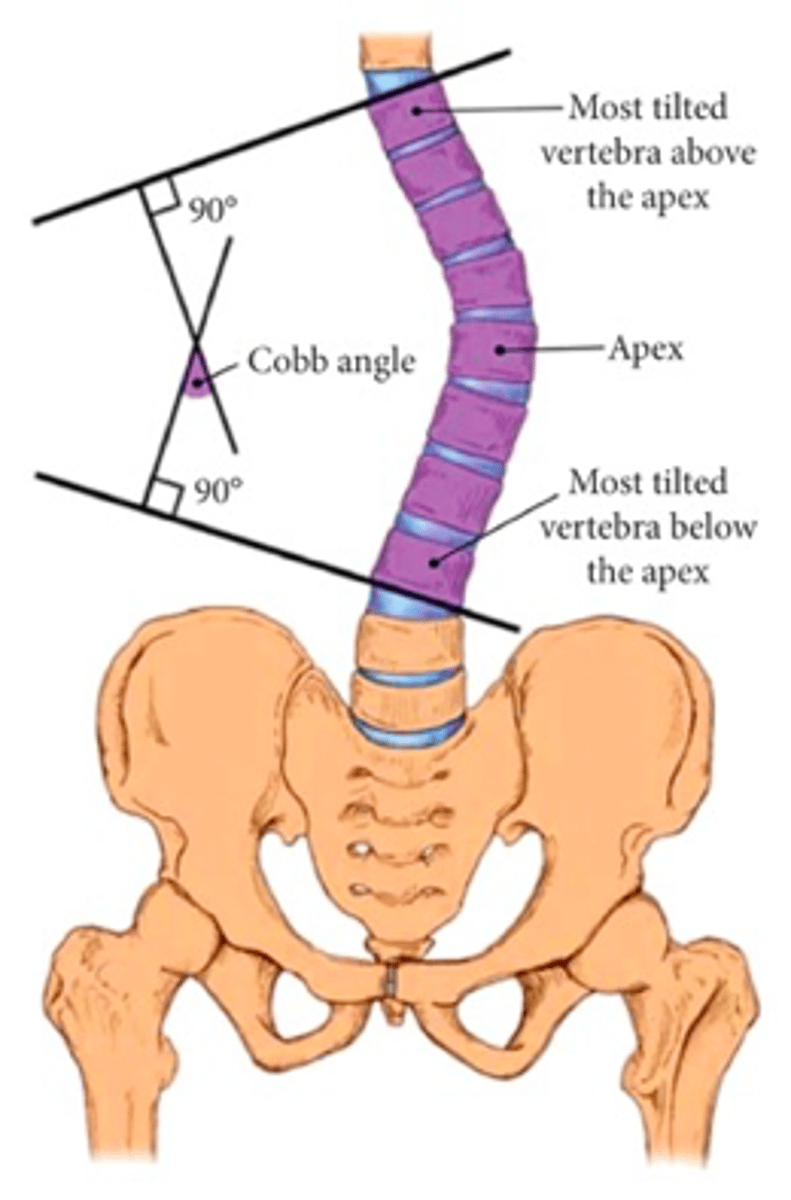 <p>Cobb angle</p><p>angle between 2 lines perpendicular to the upper and lower most involved endplate vertebrae. Helps determine severity of curvature and facilitate tx plan</p>