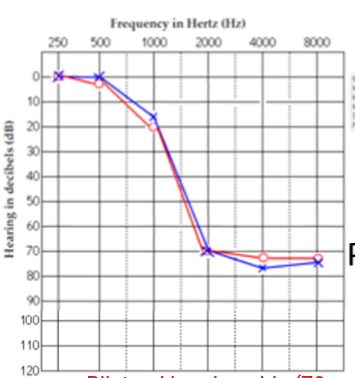 <p>What patient Is this? what kind of hearing loss doe they have?</p>