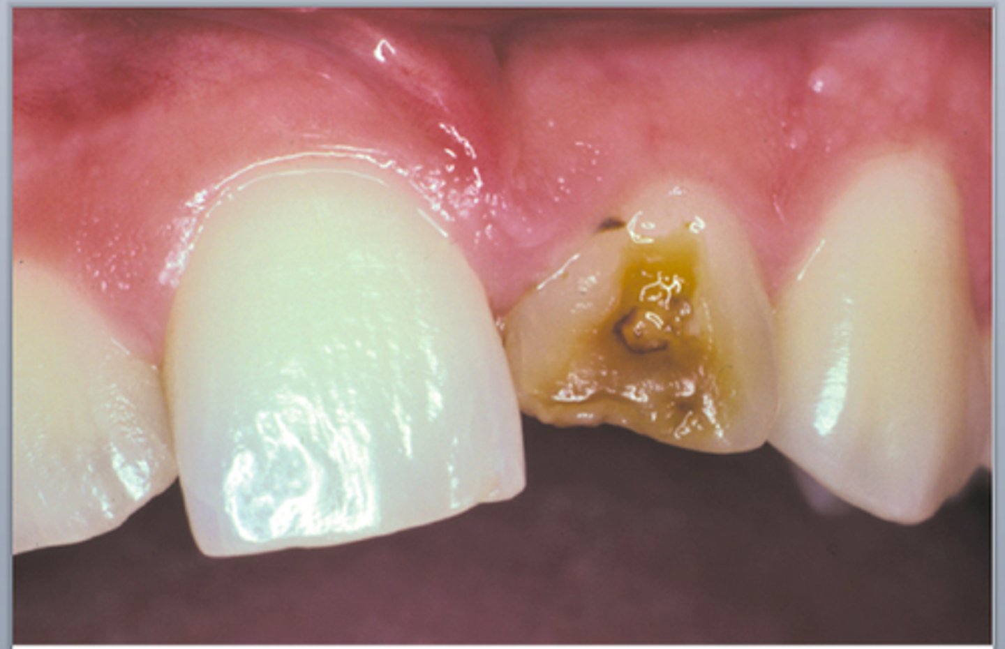 <p>Hypoplasia - results in thin enamel, making teeth more vulnerable to decay</p>