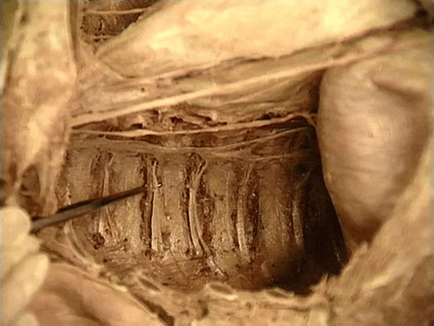 <p>on posterior wall</p>