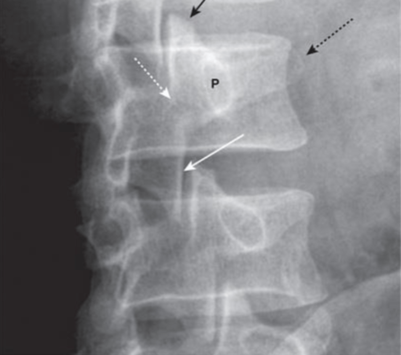 <p>Oblique view- what's this sign?</p>