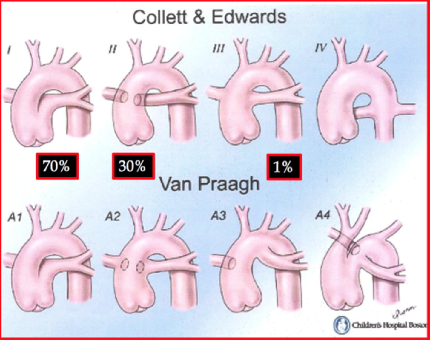 <p>Type I truncus arteriosus is characterized by the origin of both pulmonary arteries from a short pulmonary trunk.</p><p>Type II is characterized by the separate origin of the pulmonary arteries from the posterior aspect of the truncus.</p><p>Type III is characterized by the separate origin of the pulmonary arteries from the lateral aspect of the truncus.</p><p>Type IV is a pseudotruncus and is considered a form of pulmonary atresia where pulmonary arteries branches are supplied by major aorticopulmonary collaterals arising from the descending thoracic aorta.</p>