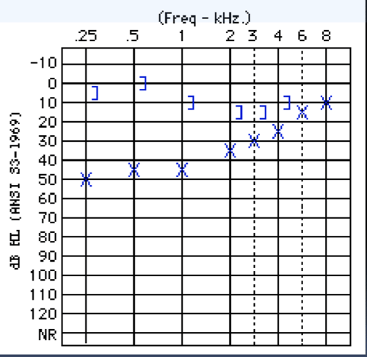 <p>- if air conduction shows hearing loss and bone conduction is normal then there is an air-bone gap and a conductive loss.</p>