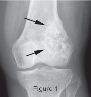 <p><strong>Osteosarcoma: Diagnosis and Treatment</strong></p><p>-Diagnosis</p><ul><li><p>___ to evaluate extent of the _________ tumor </p></li><li><p>Metastatic evaluation with bone scan and chest __</p></li><li><p>Tissue _______ (confirms), shows presence of _______</p></li></ul><p>-Treatment</p><ul><li><p>Chemotherapy</p></li><li><p>Surgical ___________</p></li></ul><p></p>