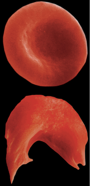 <ul><li><p>Mutation in gene that codes for protein (Hemoglobin) on red blood cells (RBCs) changes shape of RBCs from concave disc to a sickle</p></li><li><p>Sickle-cell shape leads to myriad health problems caused by low access to oxygen</p></li><li><p>Alters transport of ions, osmotic pressure</p></li><li><p>RBCs have millions of hemoglobin molecules on the surface to carry oxygen, so sickle cells do not bind enough oxygen</p></li></ul>