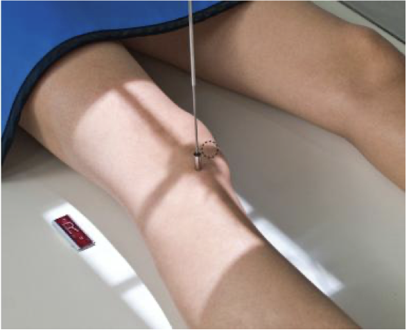 <p><span style="line-height: normal;"><span> </span></span>@ QEH not part of knee protocol; only performed if specifically requested</p><p class="p1"><span style="line-height: normal;"><span>• </span></span>Knee is rotated 45° medially &amp; then 45° laterally</p><p class="p1"><span style="line-height: normal;"><span>• </span></span>Both obliques acquired</p><p class="p1"><span style="line-height: normal;"><span>• </span></span>Centering, CR angle &amp; Collimation are the same as an AP Knee</p>