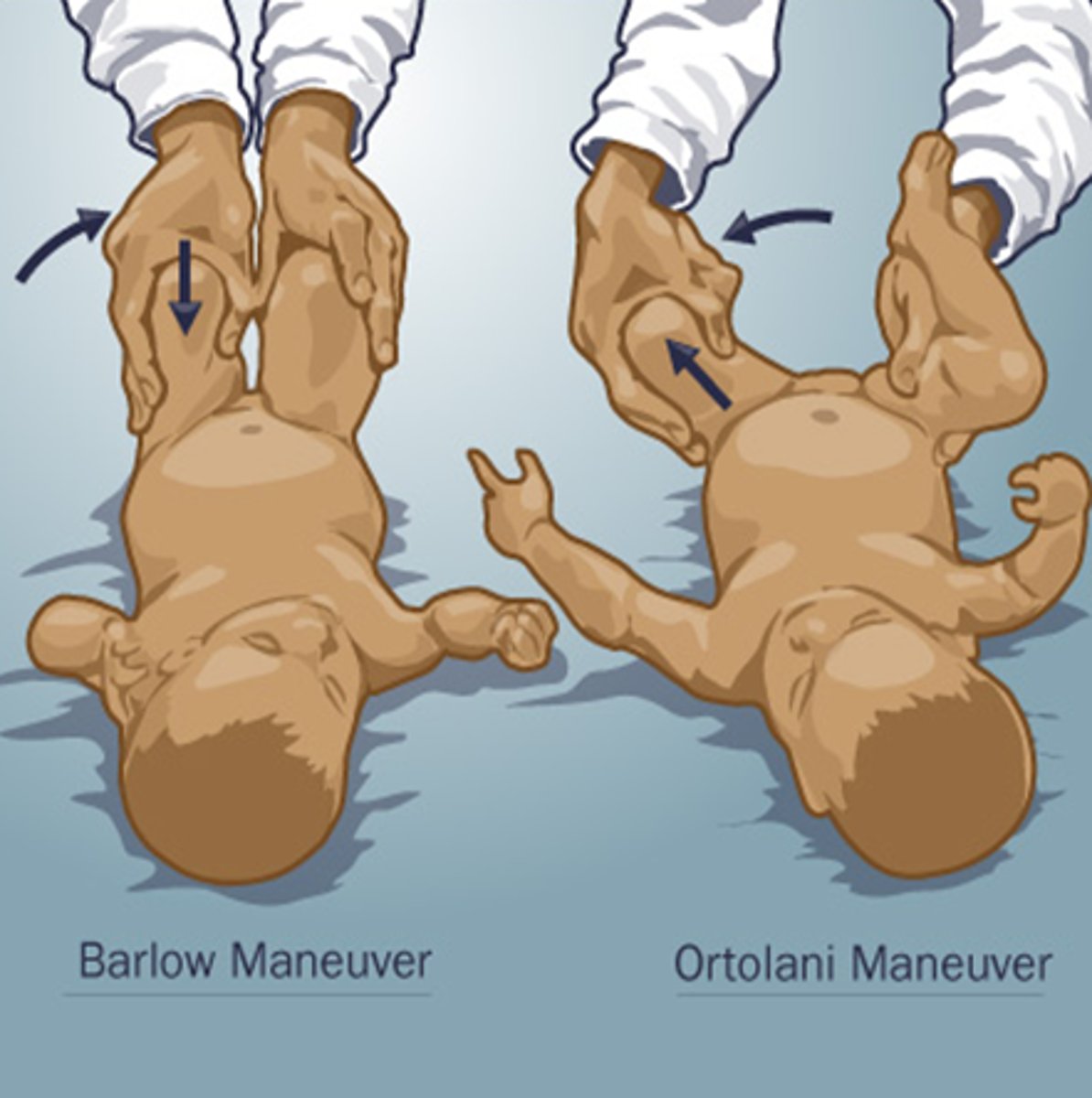 <p>ortolani test: hip is reduced by abduction</p><p>barlow test: hip is dislocated by adduction</p><p>also can do ultrasounds and x-rays</p>