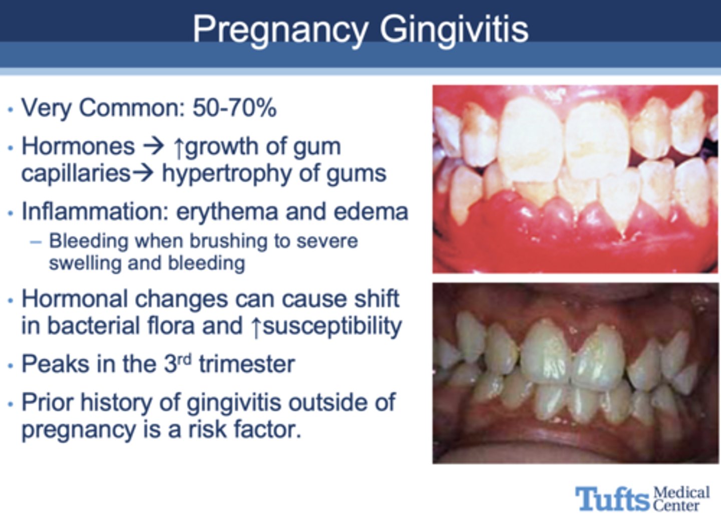 <p>gingivitis</p>