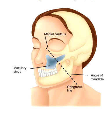 <ul><li><p>Extends from medial canthus to the mandibular angle</p></li><li><p>Theoretical line used divide the maxillary antrum into anteroinferior and posterosuperior portion</p></li><li><p>Postero/suprastructure - poor prognosis with early extension</p></li></ul><p></p>