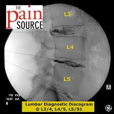 <p><span>evaluates spinal disk; contrast dye injected and CT scan performed</span></p><p></p>