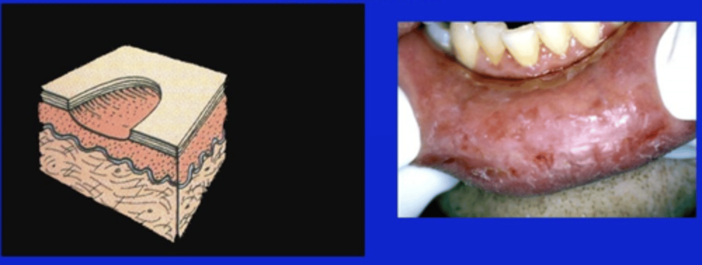 <p>denudation of epithelium above the basal cell layer</p>
