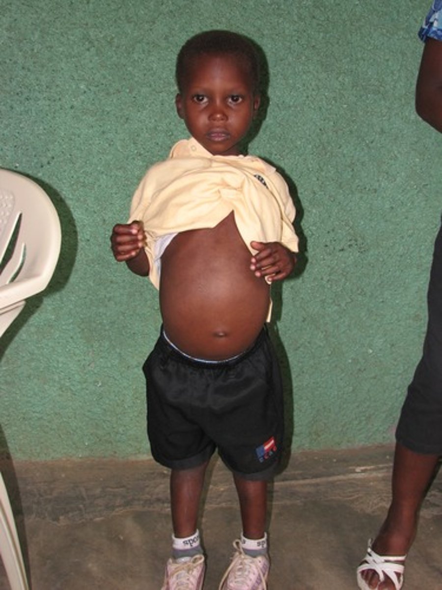 <p>- Protein deficiency only</p><p>- Adequate calories</p><p>- Children 18 to 24 months</p><p>- Edema</p><p>- Fatty liver</p><p>- A hair color change and sparse hair</p><p>- Anemia</p><p>- Lethargy</p><p>- Cracked, peeling, infection-prone skin</p><p>- Opportunistic infections</p>