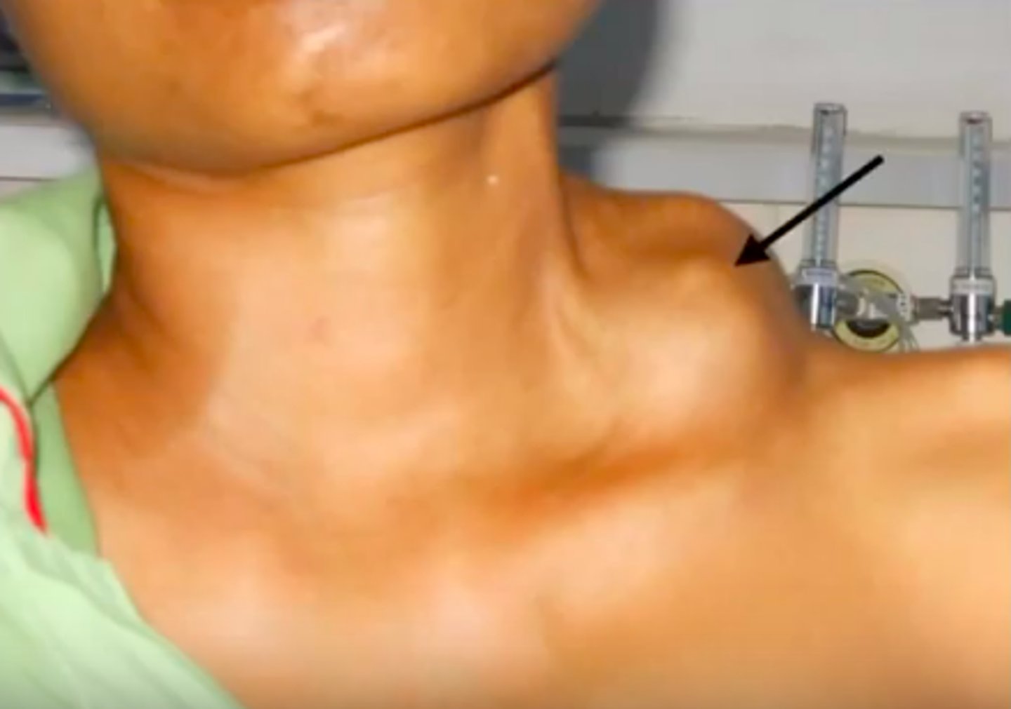 <p>- Virchow's node—supraclavicular lymphadenopathy</p><p>- Night sweats</p>