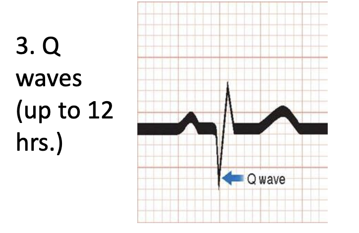 <p>Q waves (up to 12 hrs.)</p>