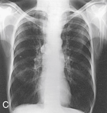 <p>Which of the following is the X-ray showing and why?</p><p>Sthenic</p><p>Hyposthenic</p><p>Asthenic</p><p>Hypersthenic</p><p></p>