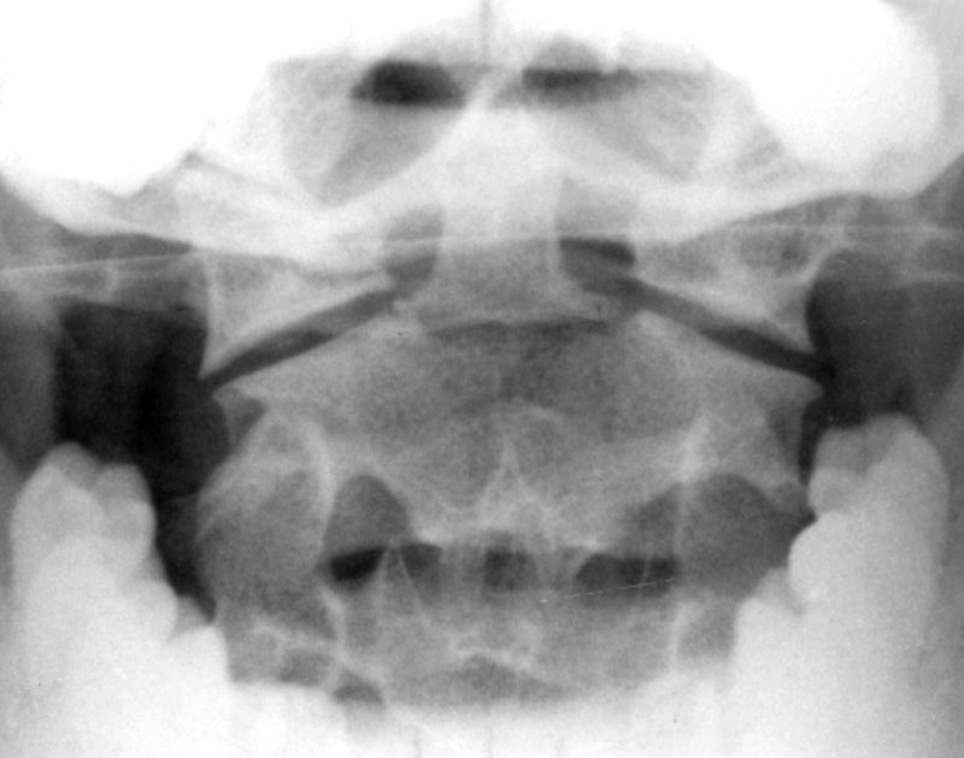 <p>fx of odontoid process of C2</p><p>caused by subluxation of C1 and C2</p>