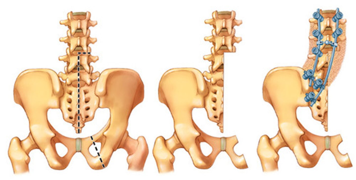 <p>Hemipelvectomy</p>