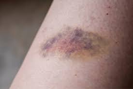 <p>on injury appear as an area of discolor on the body from ruptured blood vessels (usually flat while hematoma is bulbous and is generally smaller than a hematoma) </p>