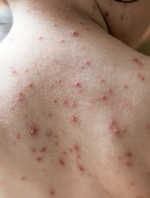 <ul><li><p>Highly contagious viral infection caused by the <strong>Varicella-Zoster Virus (VZV)</strong>.</p></li><li><p><strong>Manifestations:</strong> Maculopapular rash that progresses to characteristic fluid-filled <strong>vesicles</strong> (blisters) that eventually crust over. Lesions often appear in "crops" in different stages of healing.</p></li><li><p><strong>Risk:</strong> Can reactivate later in life as <strong>Herpes Zoster (Shingles)</strong>.</p></li><li><p>Airborne and contact</p></li><li><p>Varicella vaccine</p></li></ul><p></p>